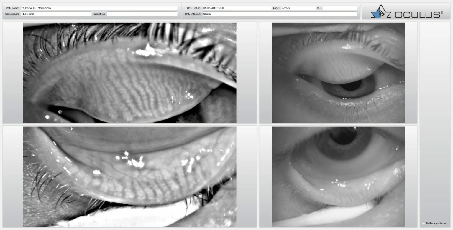 trockene-augen-meibographie.webp