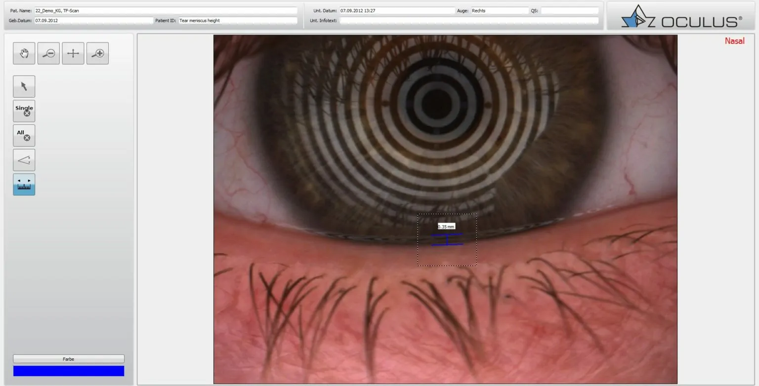 trockene-augen-meniskushoehe.webp